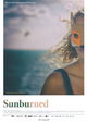 Sunburned