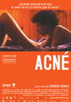 Acné